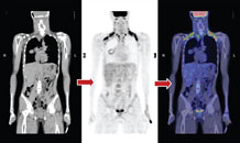 Figure a : PET-CT shows an intense brown fat uptake