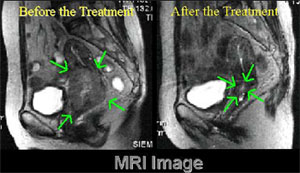 Radiation therapy of uterine cervix cancer using FNCA protocol