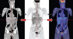 Figure b: Repeat PET-CT - no brown fat uptake over the neck region after the administration of muscle relaxant